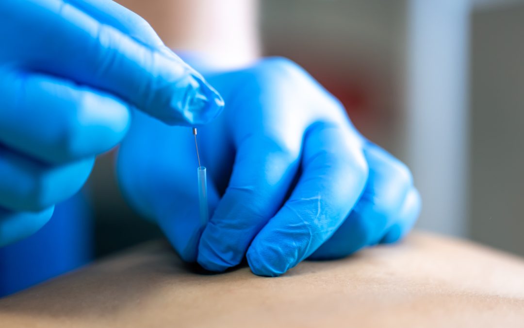 Centro de fisioterapia en Las Tablas, Madrid: ¿Punción seca?